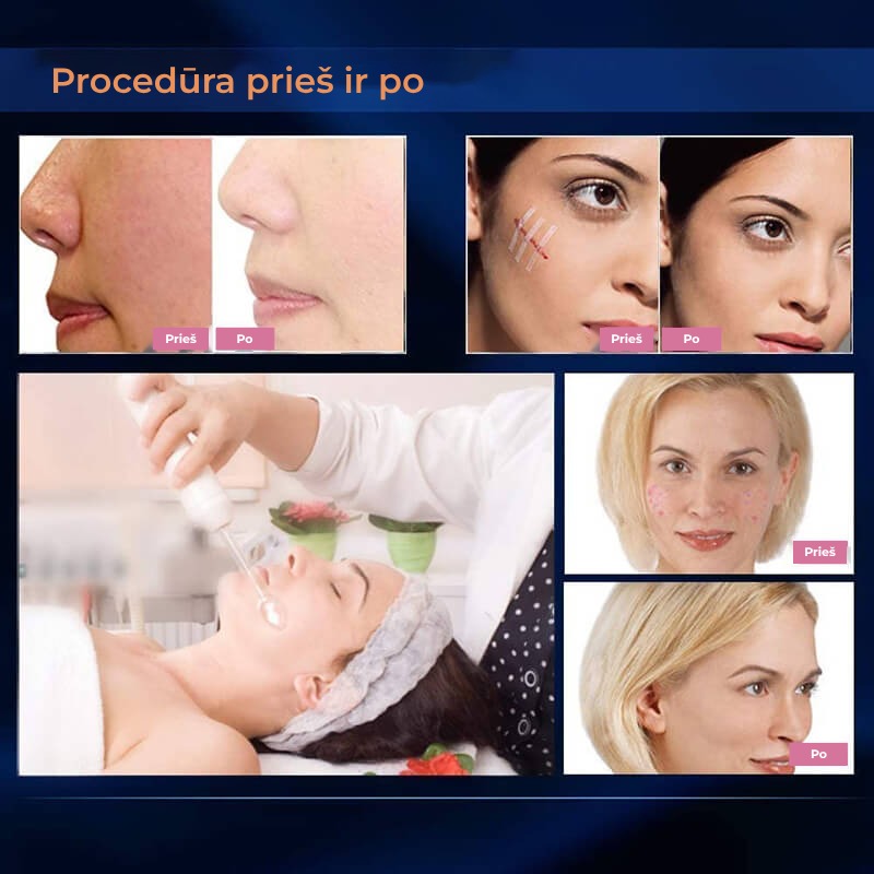aparat-cosmetic-electroderm-edman-tratamente-infrumusetare-biostimulare-faciala-lifting-profesional-4-capete-glow-gallery